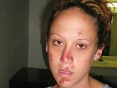 Bree Is A Skank Junkie Street Walking Ho. She Shares The Recent Story Of How She Was Beat Down Getting Road Rash On Her Face. Then Bree Proudly Shows
