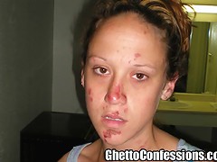 Bree Is A Skank Junkie Street Walking Ho. She Shares The Recent Story Of How She Was Beat Down Getting Road Rash On Her Face. Then Bree Proudly Shows